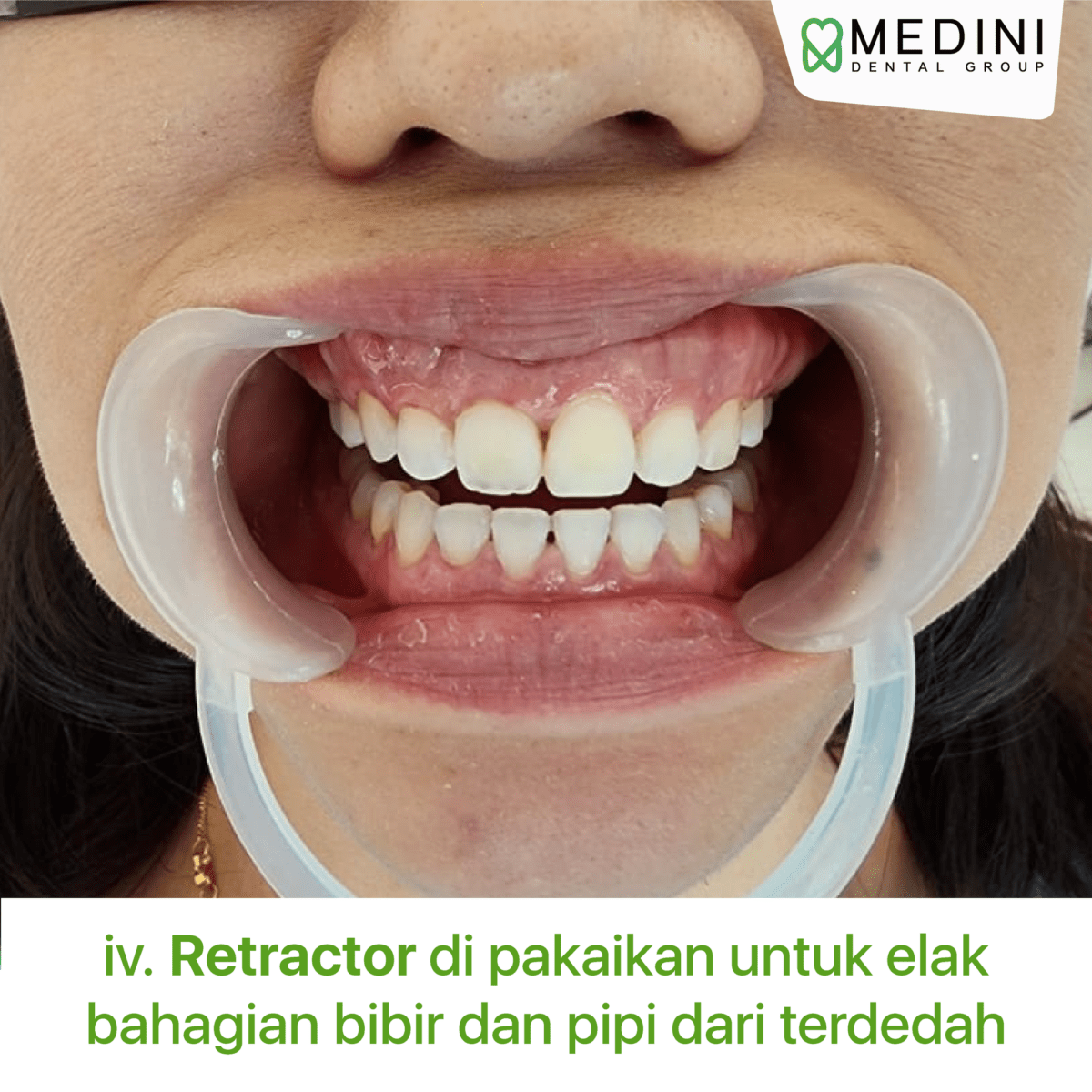 Get a Brighter Smile with Teeth Whitening in Johor bahru