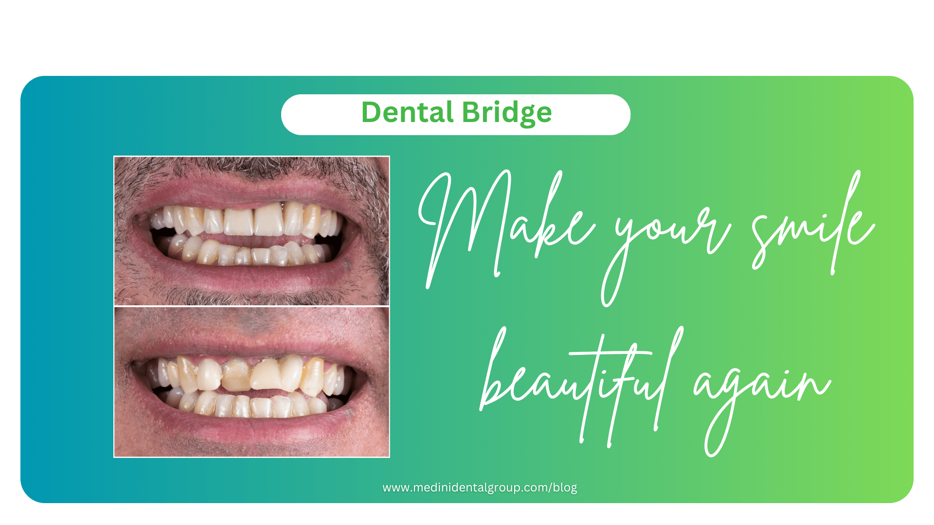 Before & After Dental Bridge