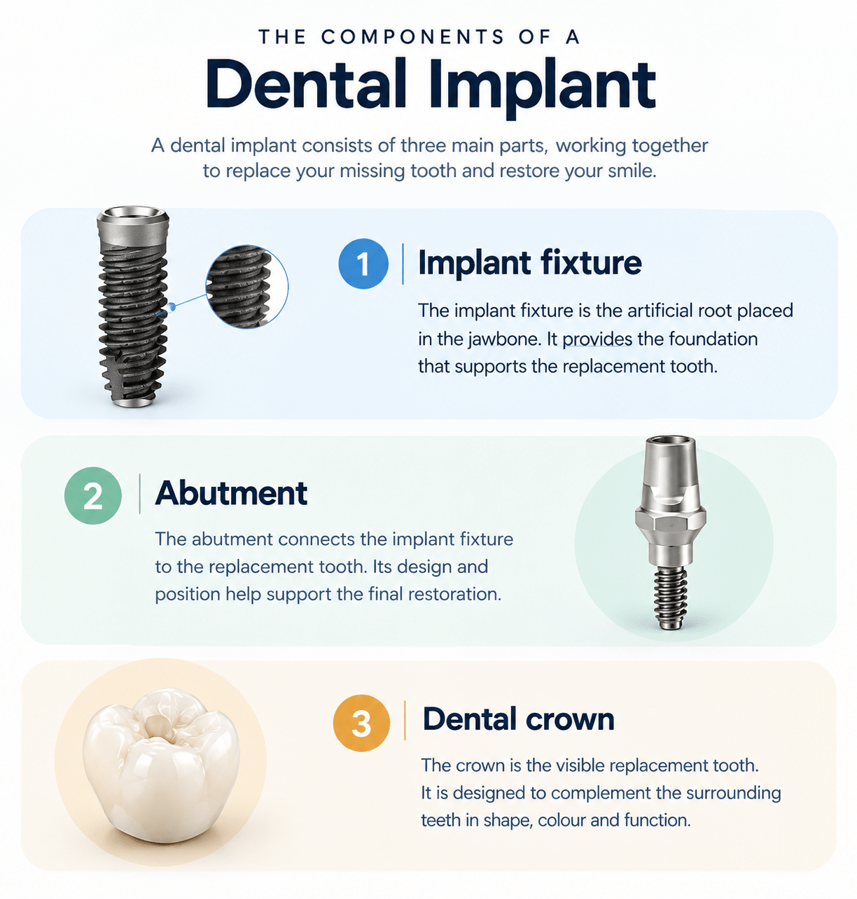 Dental Implant Components Infographic